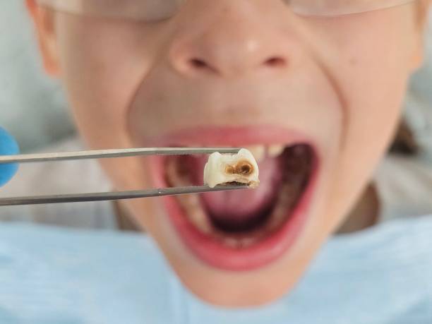 Best Emergency Dentist for Lost Fillings or Crowns in Mcgraw, NY